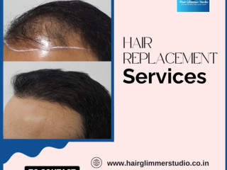 Hair Replacement in Bangalore | Hair Replacement center